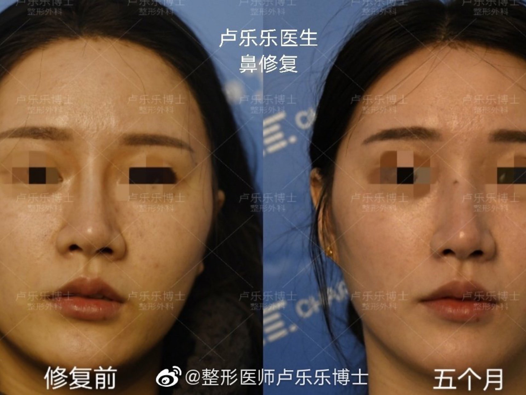 修复前鼻子山根起点高,假体轮廓感明显,鼻背生硬如刀