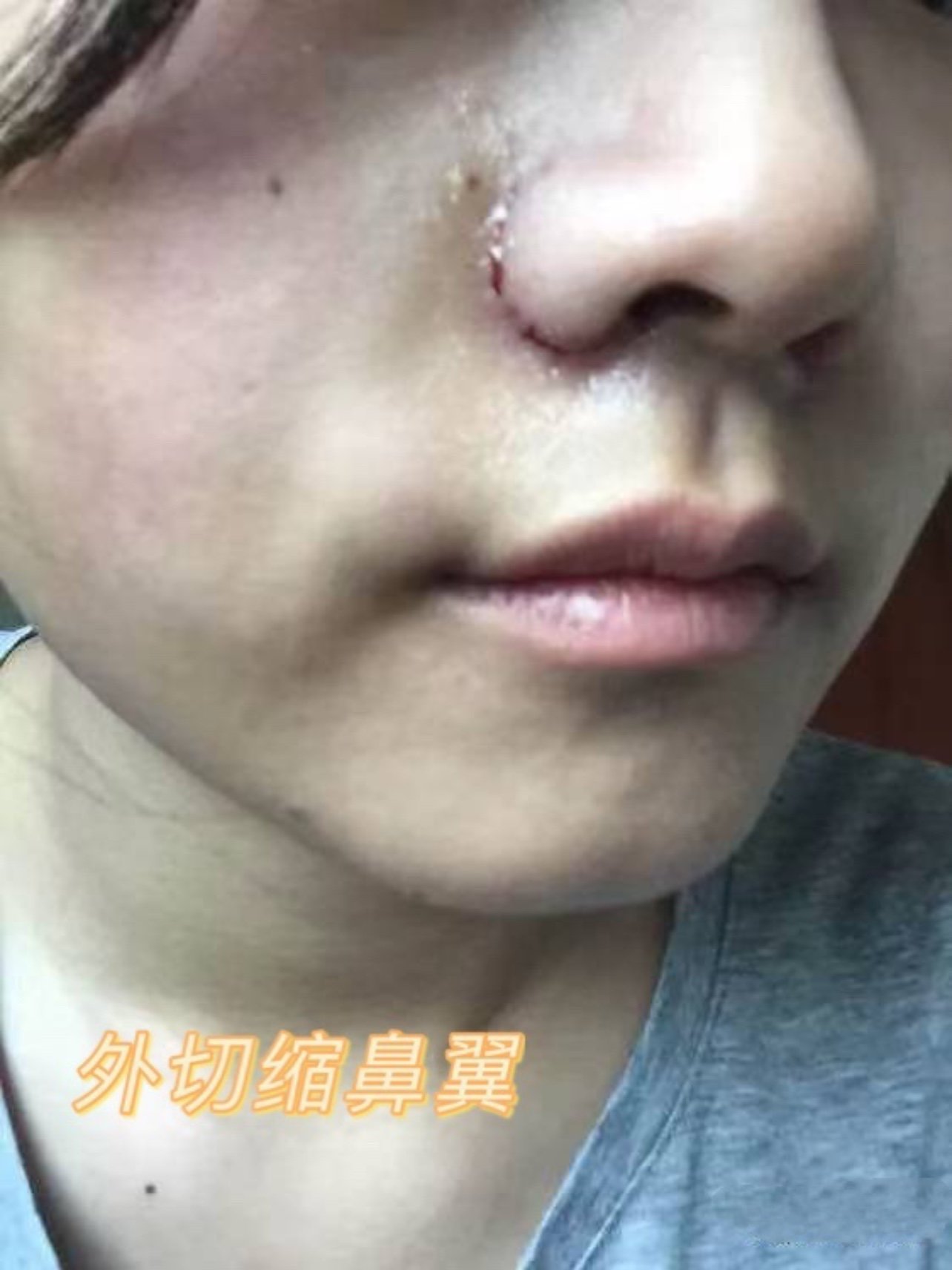 鼻翼缩小总结有4种手术方法内切外切内外切全层切除皮瓣法埋线法