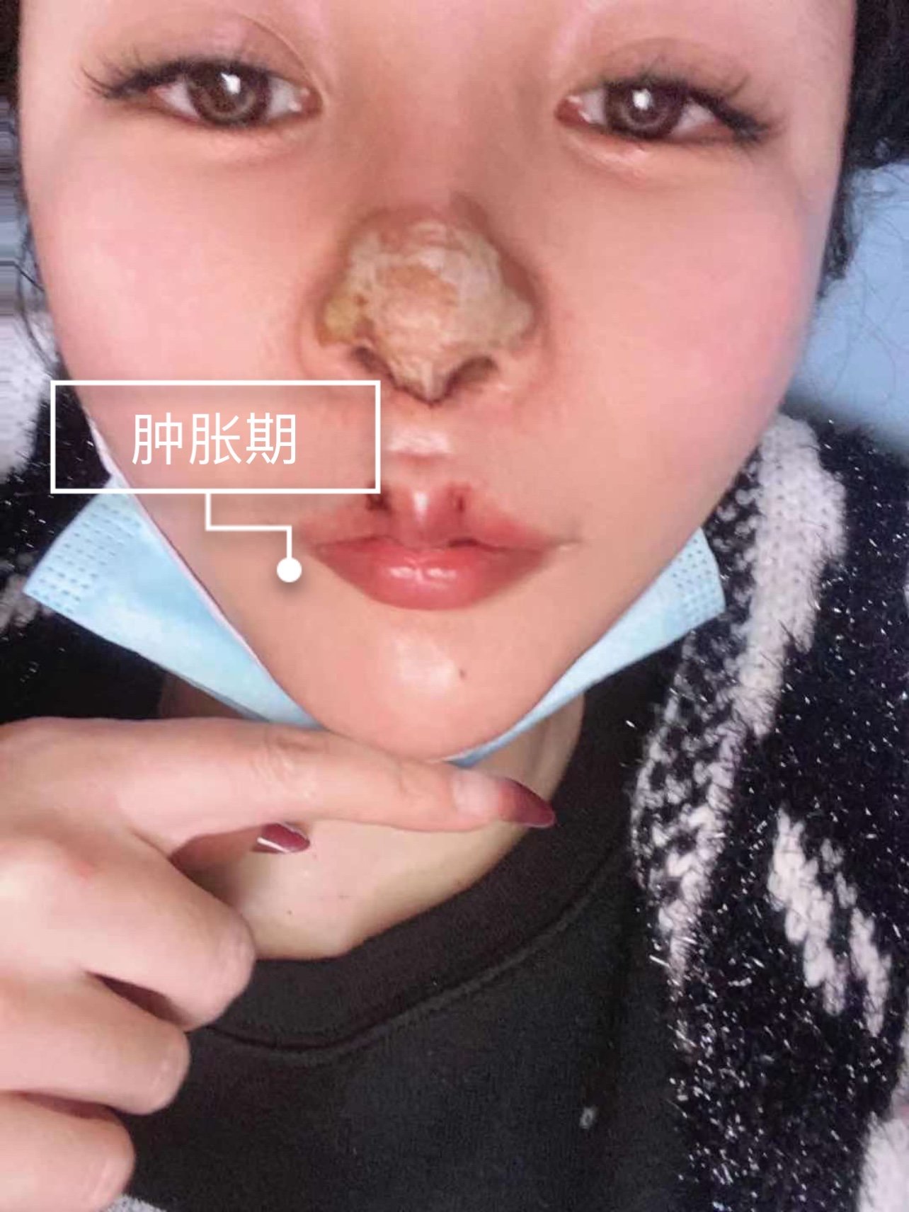 埋线人中缩短速愈美线雕lt3人中缩短术后第1天