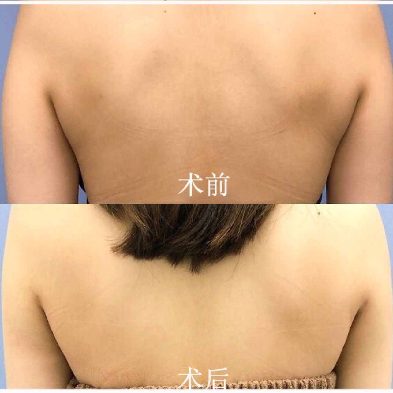 背部吸脂手术的优点和适应症