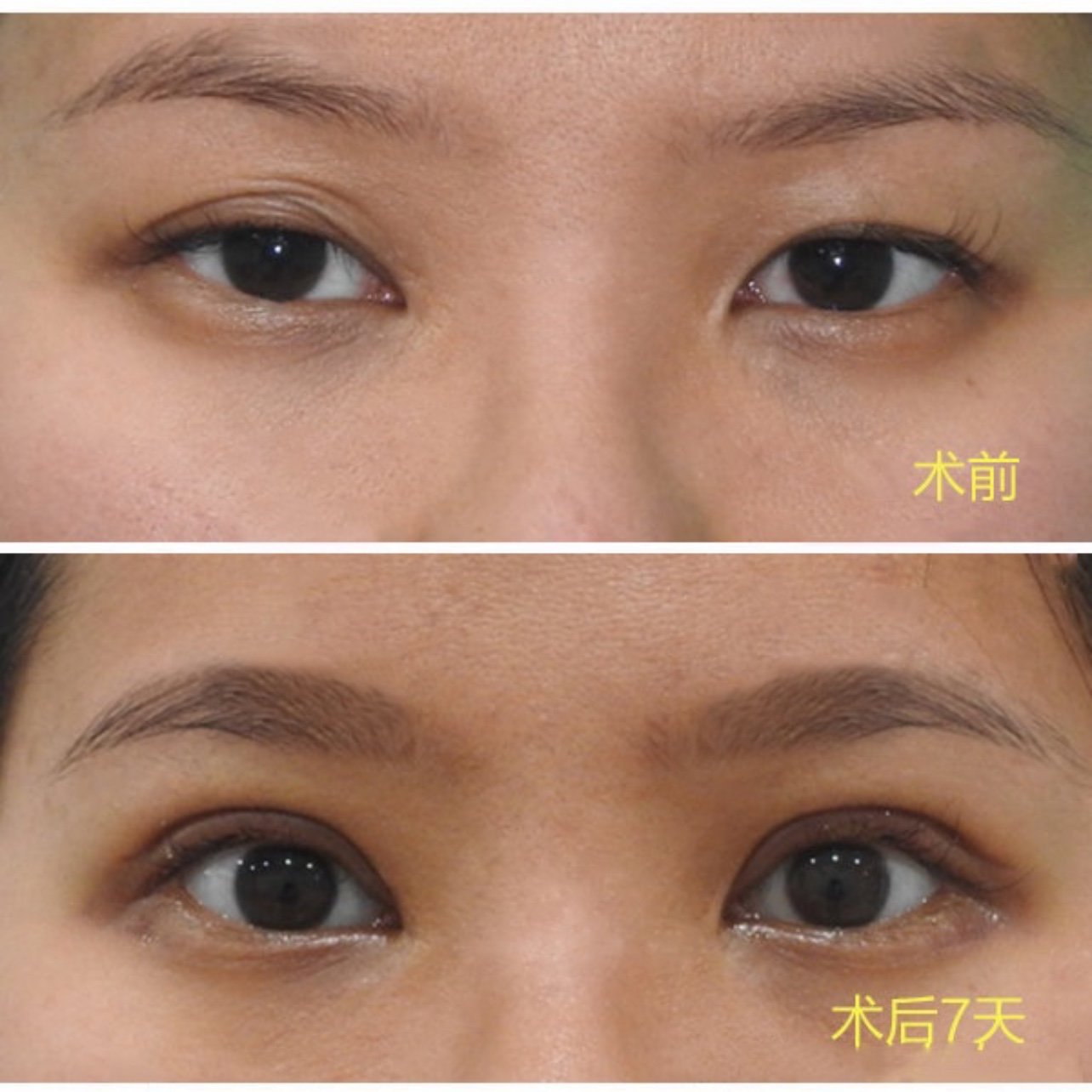 术前:姑娘术前右眼粘连,整个双眼皮呈现多重褶的不良
