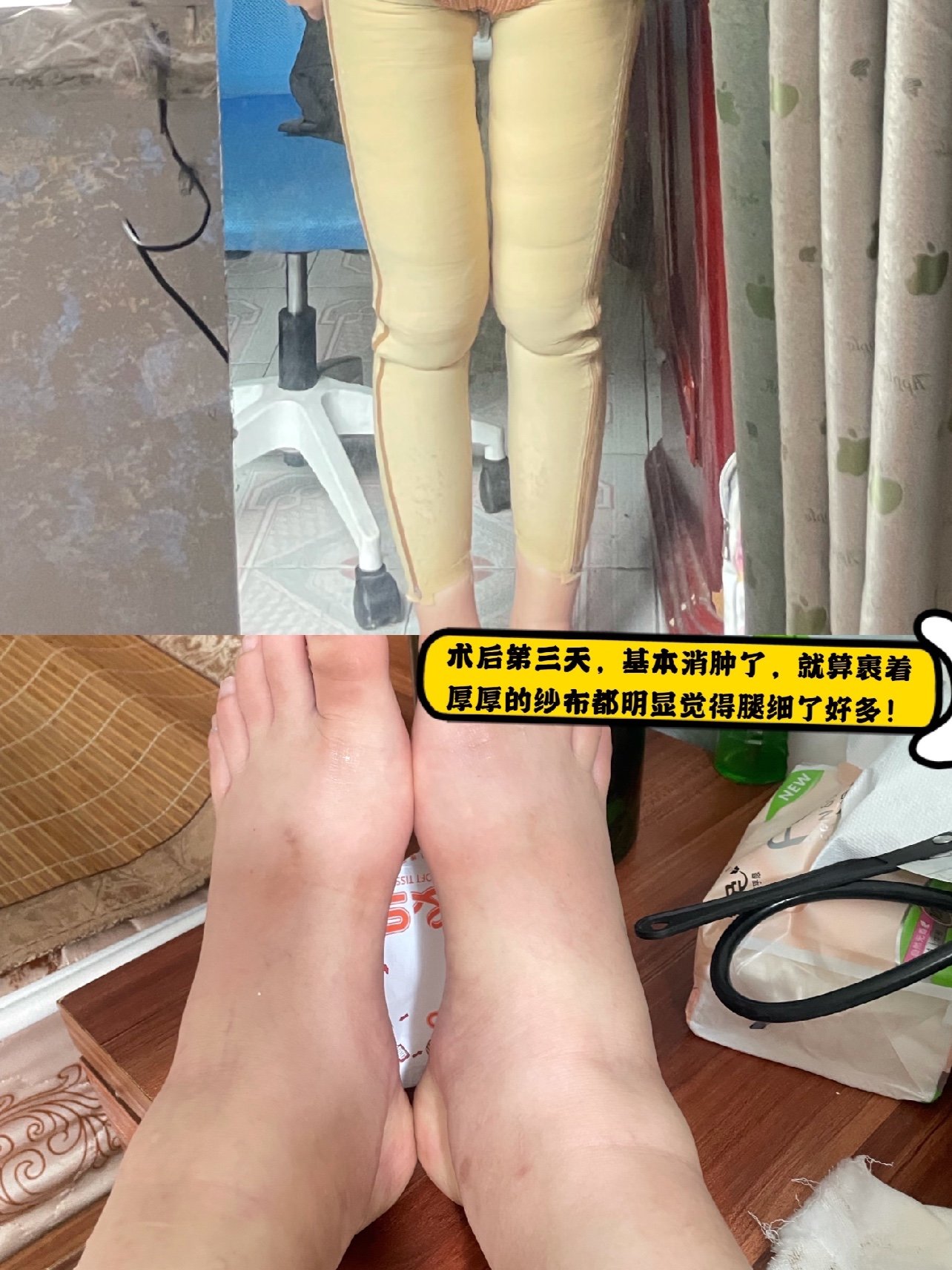 大腿环吸