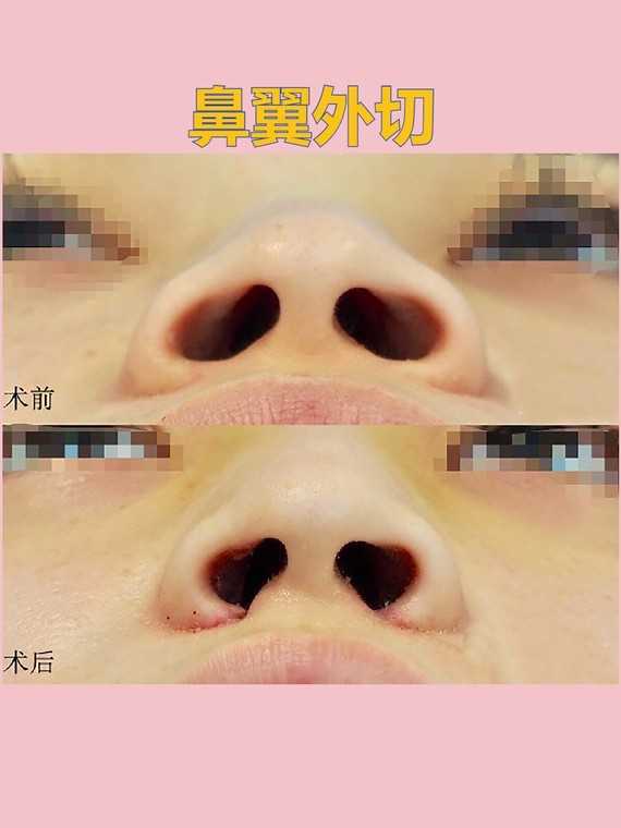 鼻翼外切来看看这个案例93,术前鼻翼宽大,鼻孔大