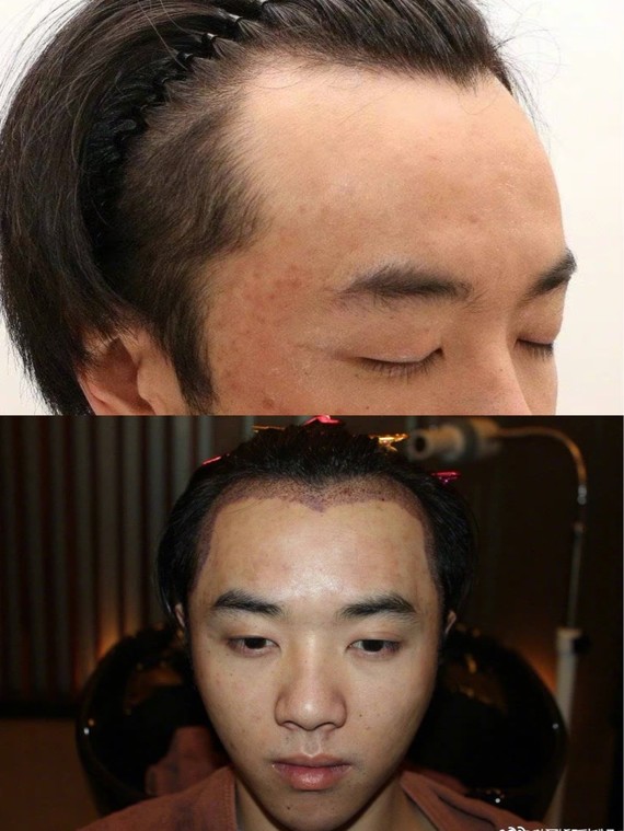 "秃"如其来,华晨宇也逃不过脱发?