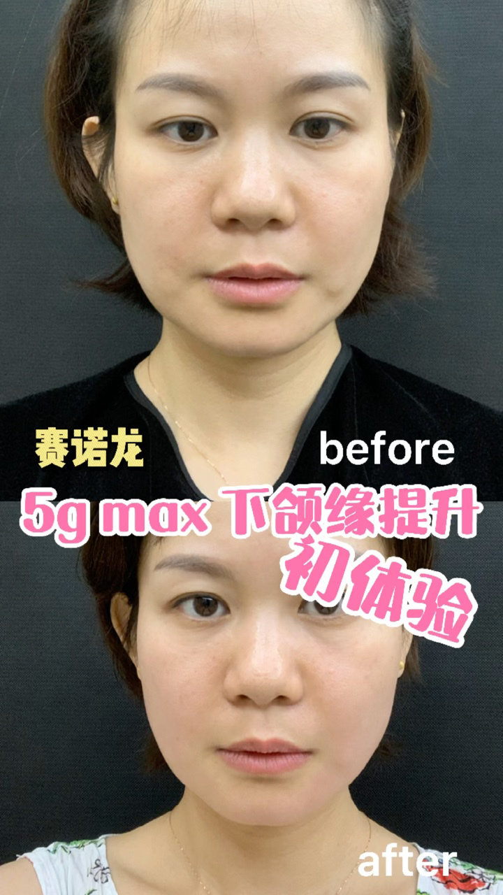 赛诺龙5gmax下颌缘提升效果初体验#7月热议榜_圈子-新氧美容整形