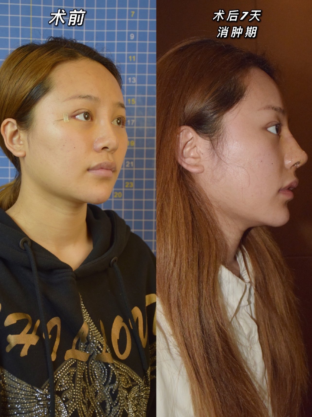 在直鼻后翘鼻之后,直鼻微翘成为今年受大众欢迎的鼻型