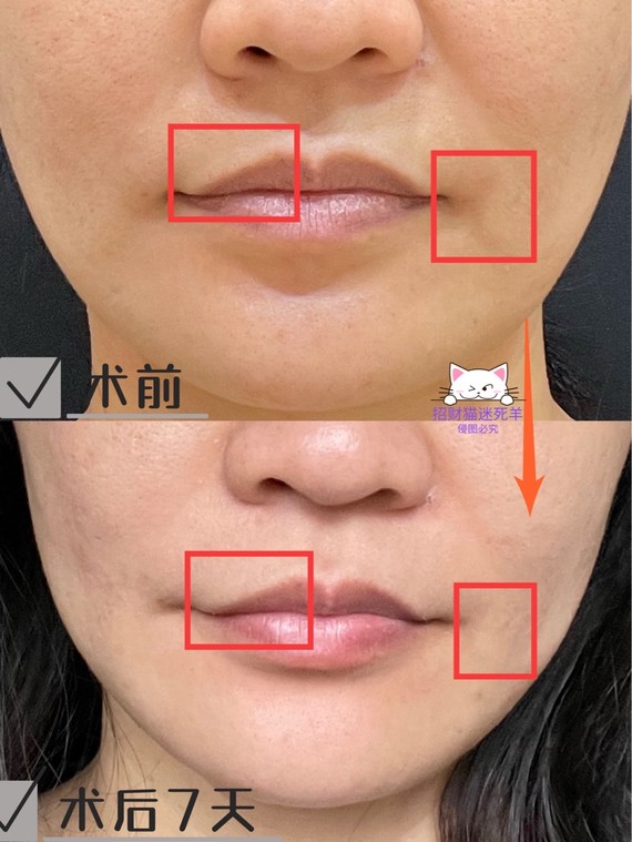 为了解决口周衰老的问题,上个礼拜我去做了菲欧曼口周年轻化项目.