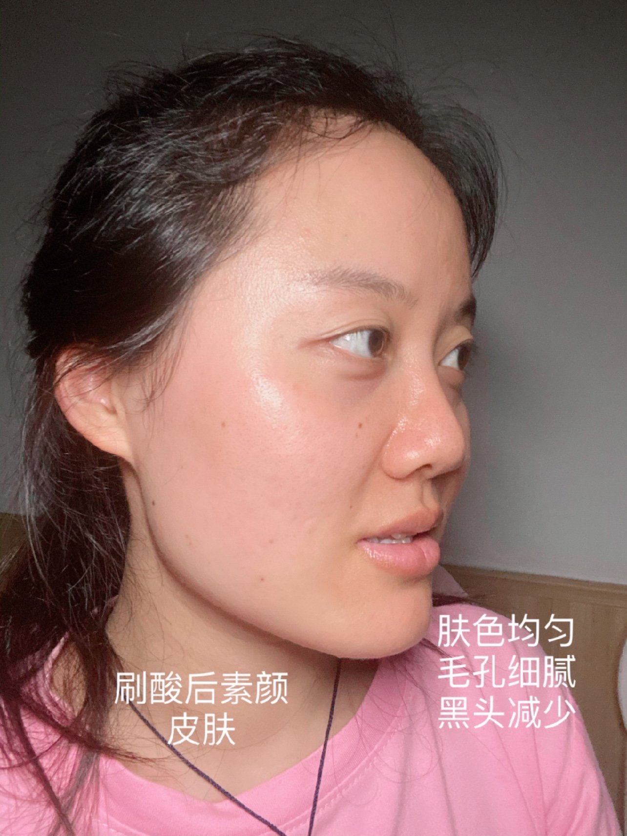 我为什么建议大家肤色暗沉的情况下最好去刷酸呢?