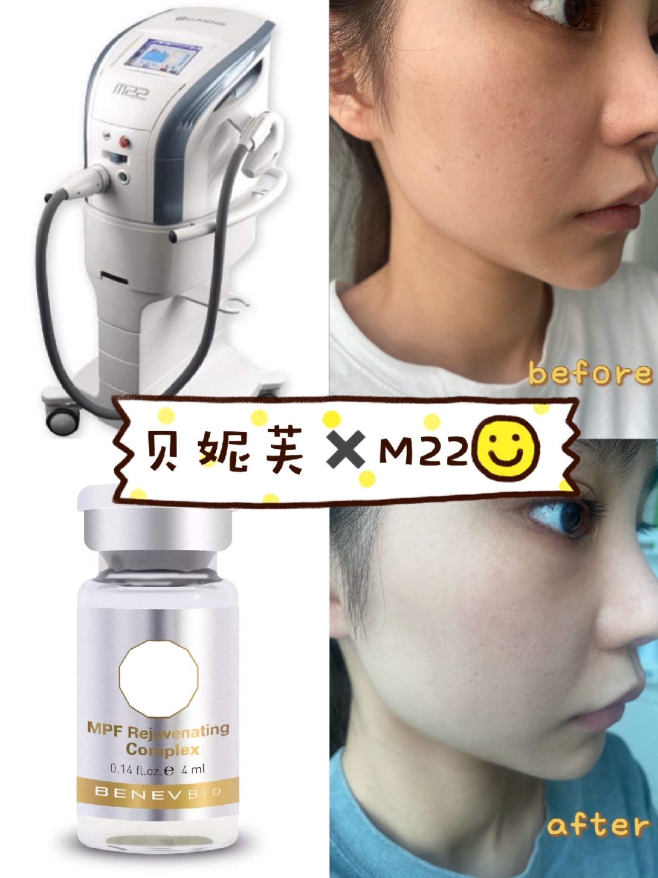 贝妮芙&m22超光子联合治疗