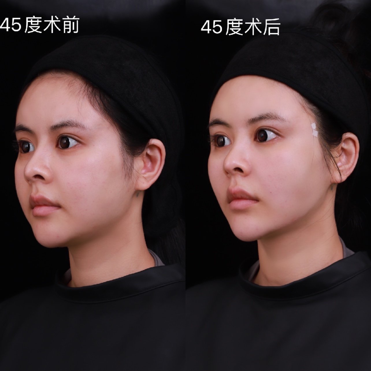 强生鱼骨线7878hi~各位宝宝们,我终于去做了线雕