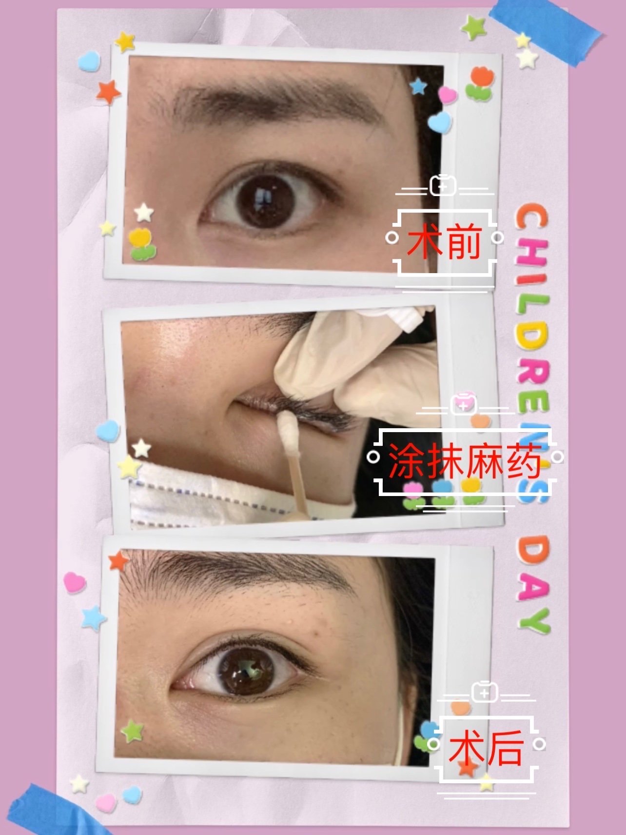 大家好,做完美瞳线已经一周了,现在正处于反色期,那么什么是反色期呢?
