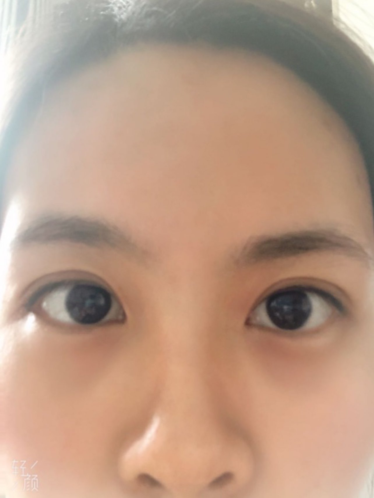 中度上睑下垂,眼睛无神呆滞,要求做切开双眼皮