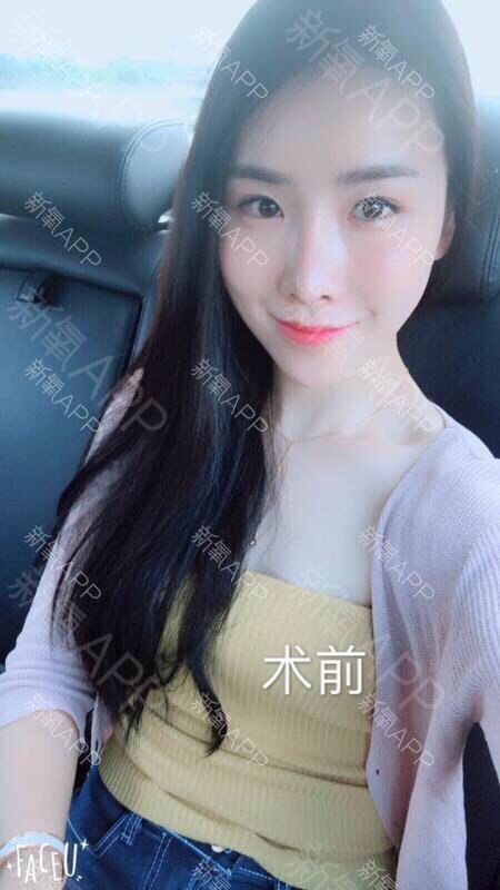 【假体隆胸】曼托水滴假体隆胸 自然聚拢 不伤乳腺 无