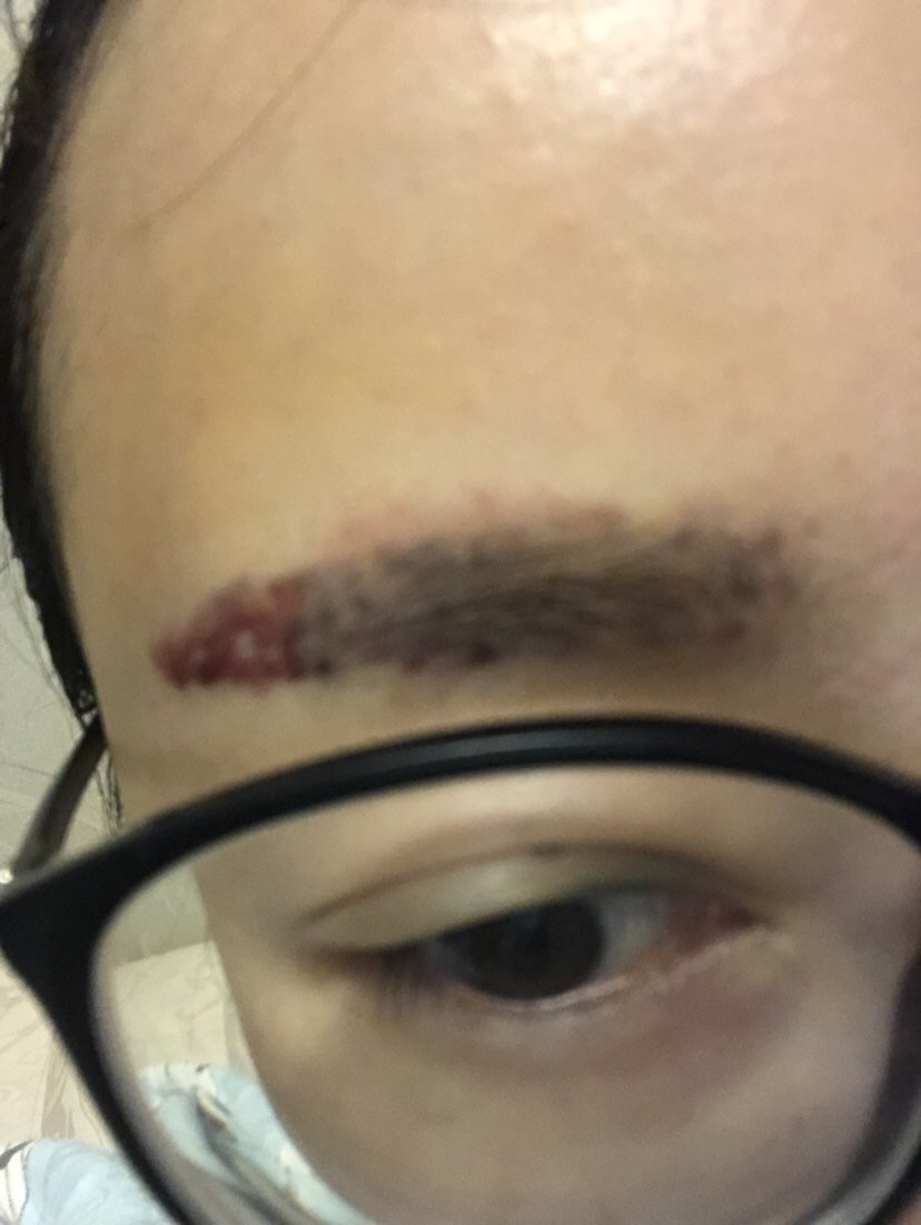 我的眉毛现在底色是红色,都说红色是比较难去除的,这个激光洗眉