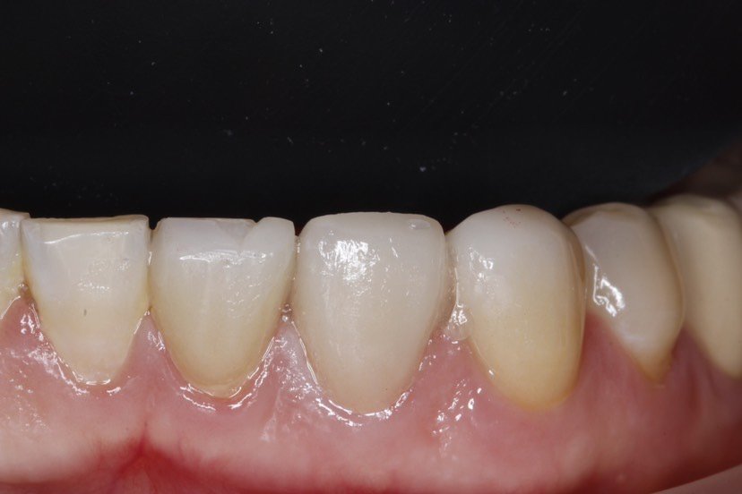 最开始牙齿做了根管治疗没有好好的保护导致后面牙齿