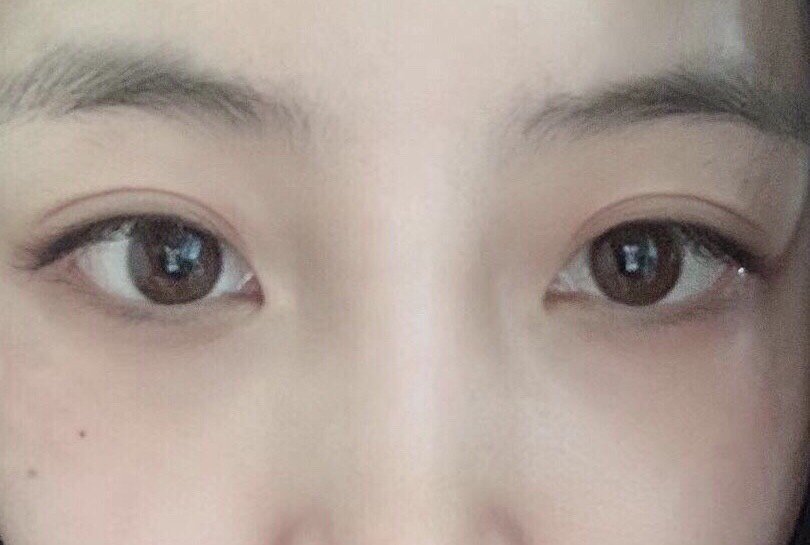 【切开双眼皮】周年庆限享价 #少女眼/芭比眼/无辜眼