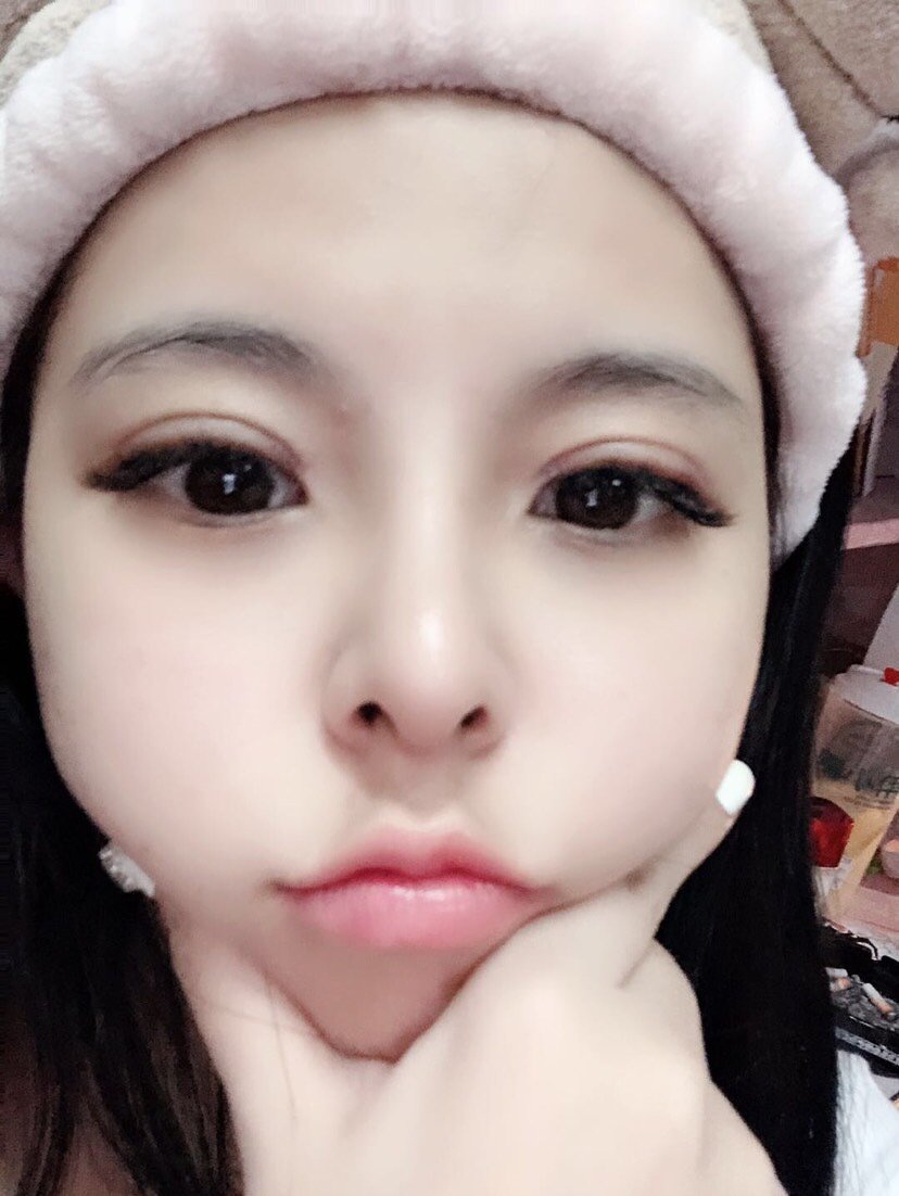 【切开双眼皮】【拼团超值】全切双眼皮 萌系无辜大眼