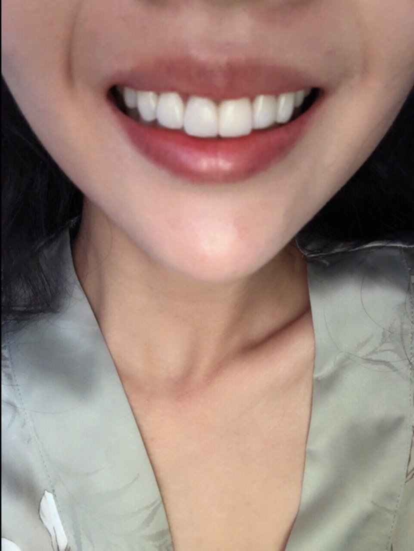 很细心安全的感觉 对比了几套方案之后决定做牙贴面!