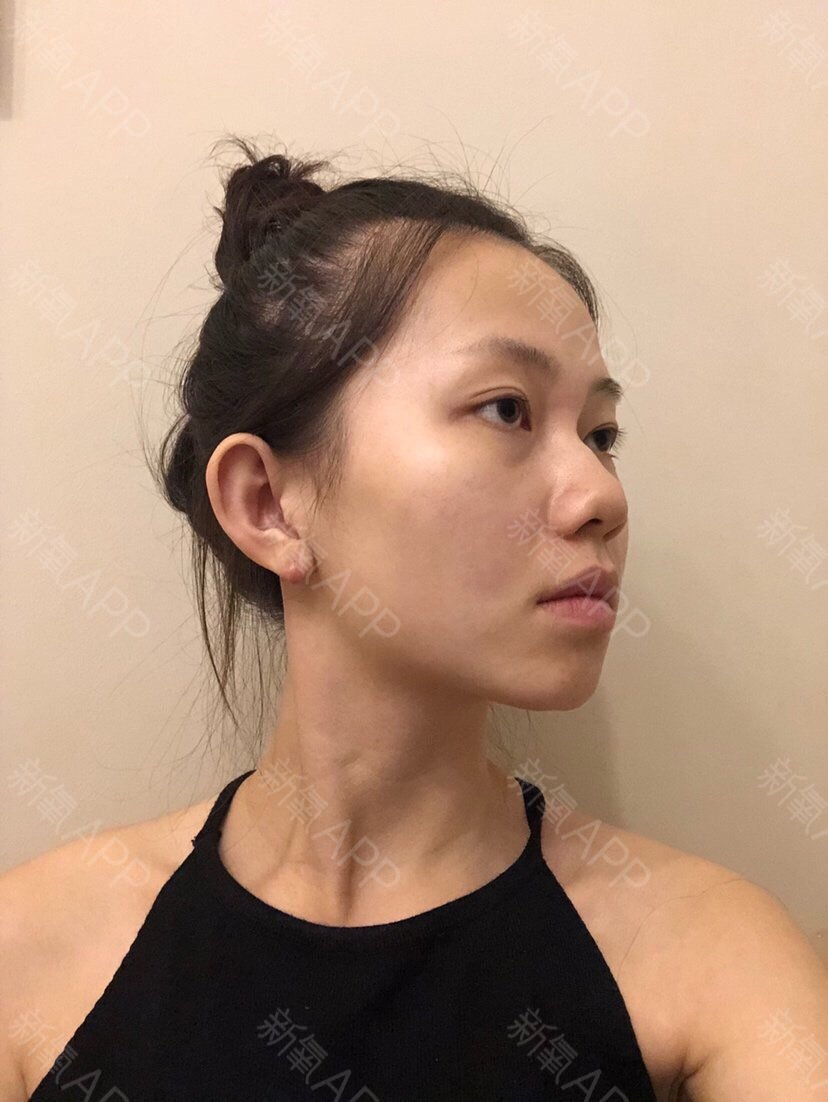 【除皱瘦脸】【下颌缘提升】 分层多点注射 打造明星v