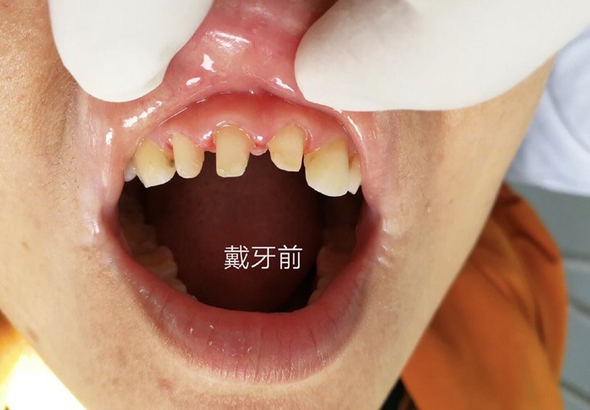 之前在别的地方做的是金属烤瓷牙,一点也不好,容易碎