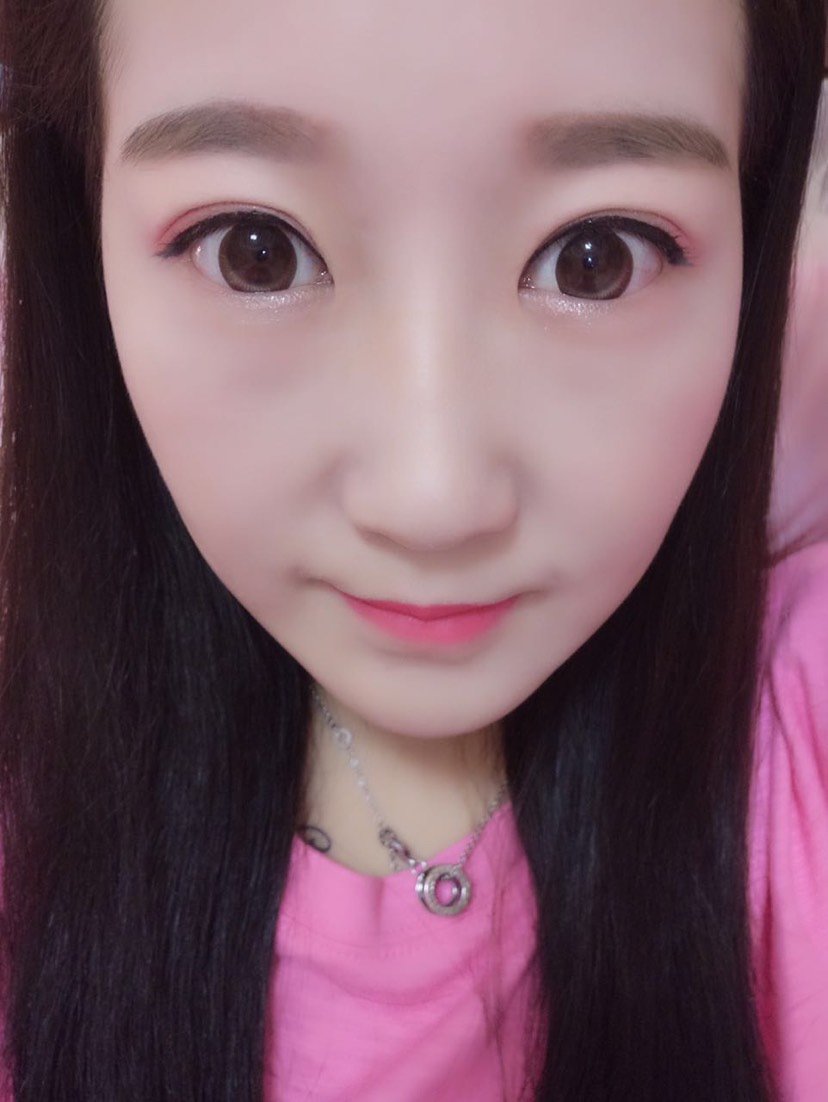 【内眼角修复】【王振军内眼角一级修复】解决过圆过尖内眼角/疤痕不