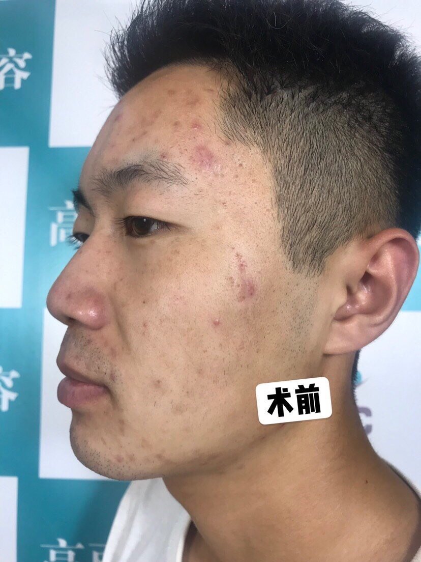 白嫩肤 改善方案:g-max激光消炎 飞梭 mts微针 说一下我面部大概的