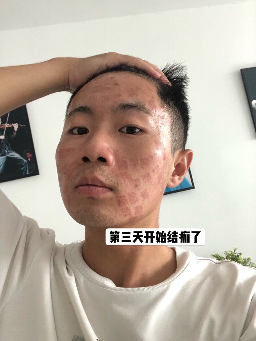 白嫩肤 改善方案:g-max激光消炎 飞梭 mts微针 说一下我面部大概的