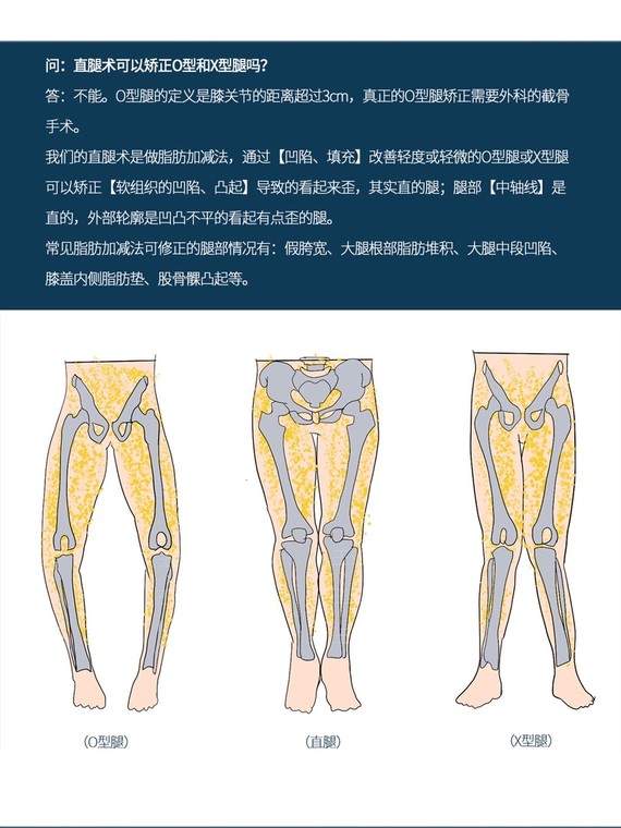 o型腿的定义是膝关节的距离超过3cm,真正的o型腿矫正需要外科的截骨