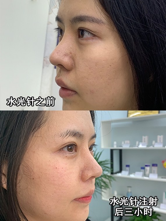 注射后即刻:刚注射完水光补水后的三小时,虽然能看得出脸上的小皮丘