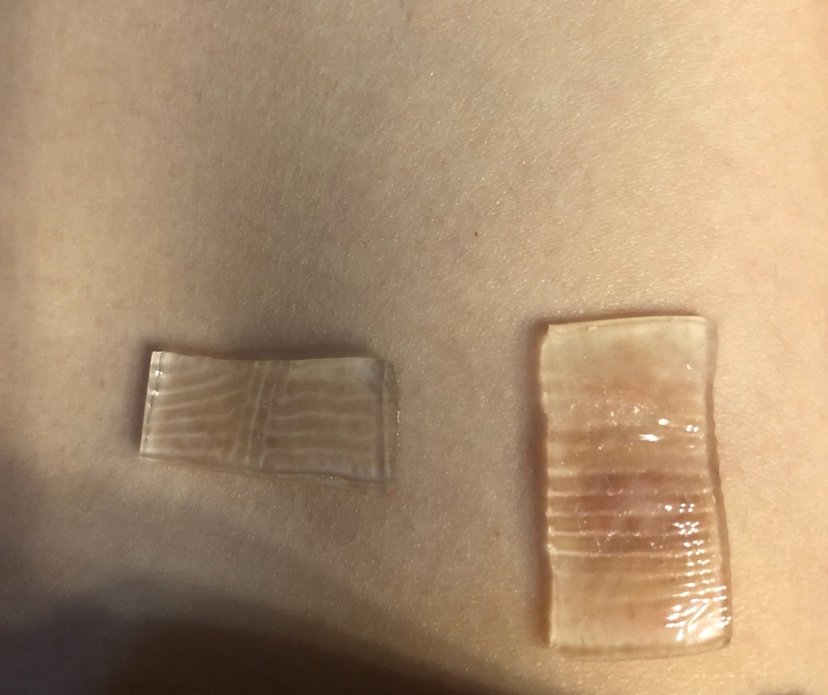 大腿抽脂后左右两侧都有这个疤,一直痒痒的,要怎么处理掉?