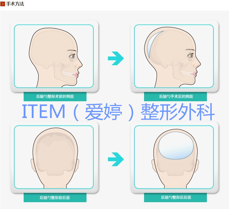 有很多的朋友在问 "什么是后脑勺整形?