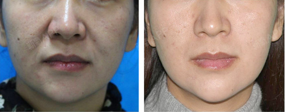 等离子传统溶脂有效面对激光减肥必须解决的皮壳聚糖是什么瘦身减肥图片
