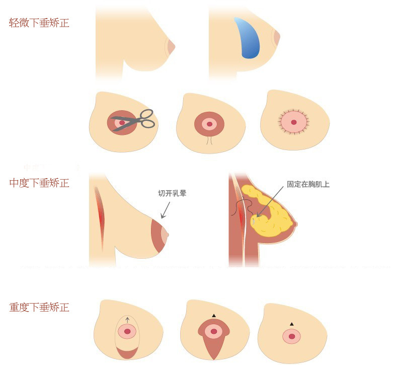 常见的矫正乳房下垂的整形手术为,悬吊下垂的乳房整形方法