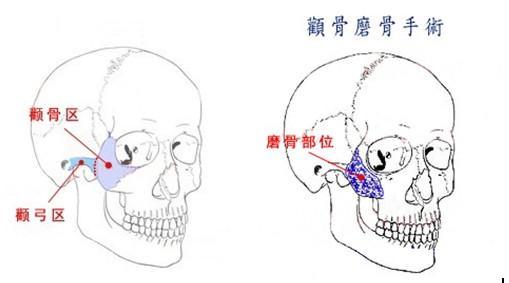 先在耳前以小切口,斜形截断颧弓后方,然后以口内切口暴露上颌骨颧突和