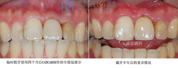种植牙的优点和缺点有哪些?作为一种先进的牙