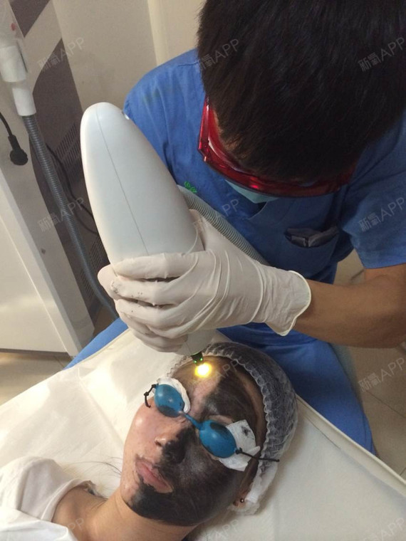 港口区HLumenisclinic美容外科碳粉激光爆破黑