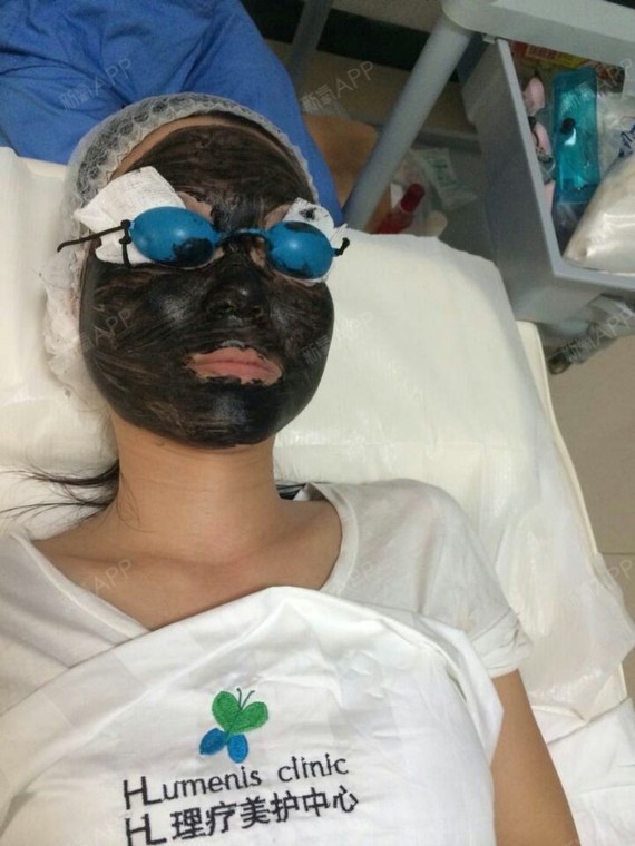 港口区HLumenisclinic美容外科碳粉激光爆破黑