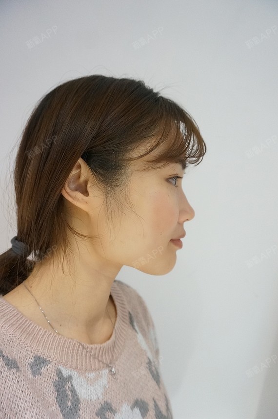【韩国jj洪镇柱整形外科医院免费整形活动 四方脸宽大下颌角求改变】