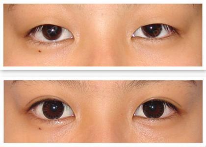 埋线法割双眼皮适应于眼睑薄,无臃肿,眼睑皮肤无松弛,无内眦赘皮的