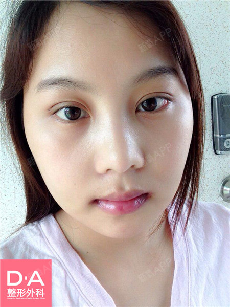中国患者-雅婷【双眼皮埋线两颚颜面轮廓】术后1个