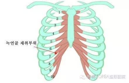 【假体隆鼻】挺一点,会更美