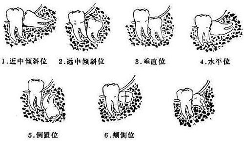 很多人困惑,到底什么是智齿,长了智齿一定要拔掉吗,对人体有什么影响