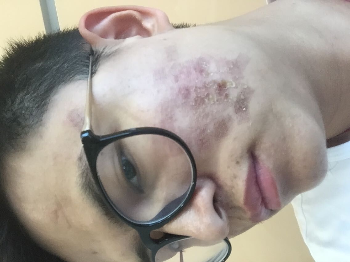 术后第二天啦,跟之前一样,结痂了,从照片看自己,真真的不想要这张脸了