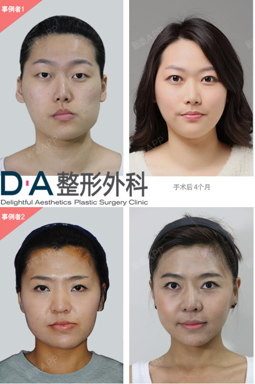 韩国da整外科-颜面不对称手术 不对称严重的情况,咀嚼时下巴力度