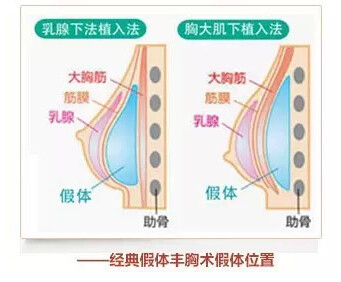 【纠结是选择假体丰胸好还是自体脂肪丰胸好呢?】