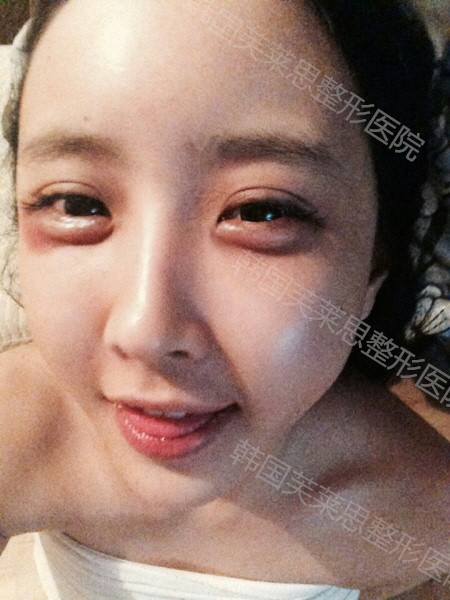 新氧- 芙莱思整形外科 | 术后当自强 | 自体脂肪移植丰额头 | 韩国