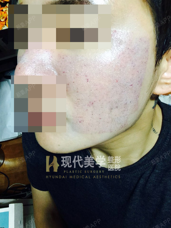 【这位帅哥在我院做了fraxel飞梭镭射,因为效果_圈子
