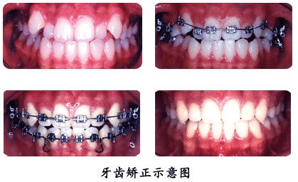 牙齿矫正正畸基本流程