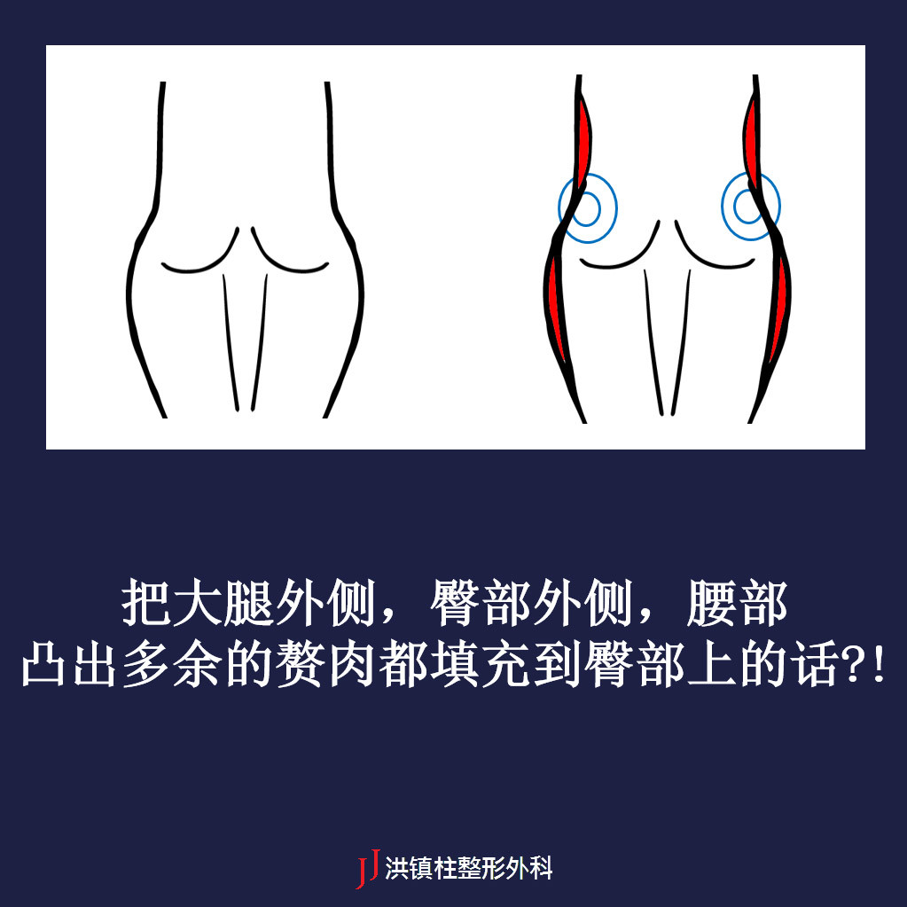 把大腿外侧,臀部外侧,腰部凸出多余的赘肉都填充到臀部上的话?