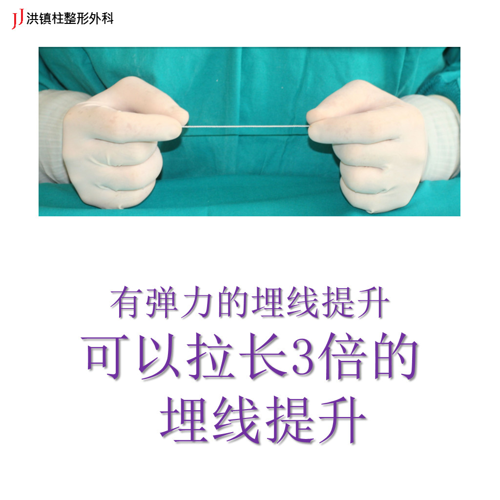 韩国整形##图片新闻##jj图片新闻##线提升术##el